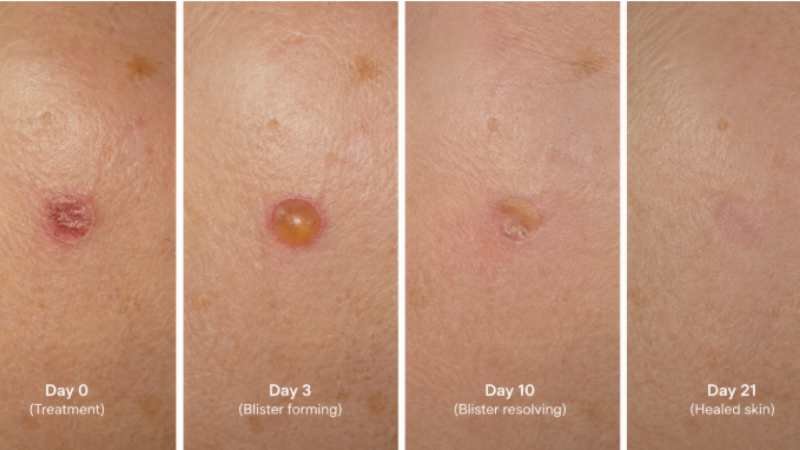 hoto sequence: day 0 (treatment), day 3 (blister forming), day 10 (blister resolving), day 21 (healed skin)