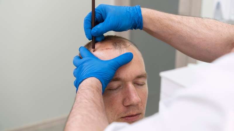 Hair Transplant
