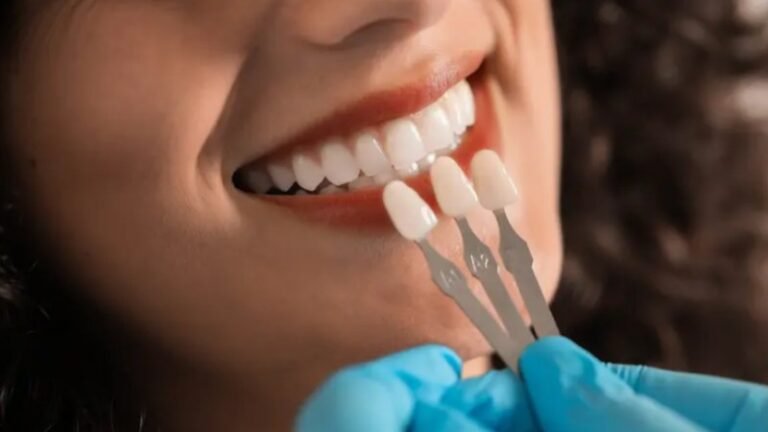 Porcelain Veneers