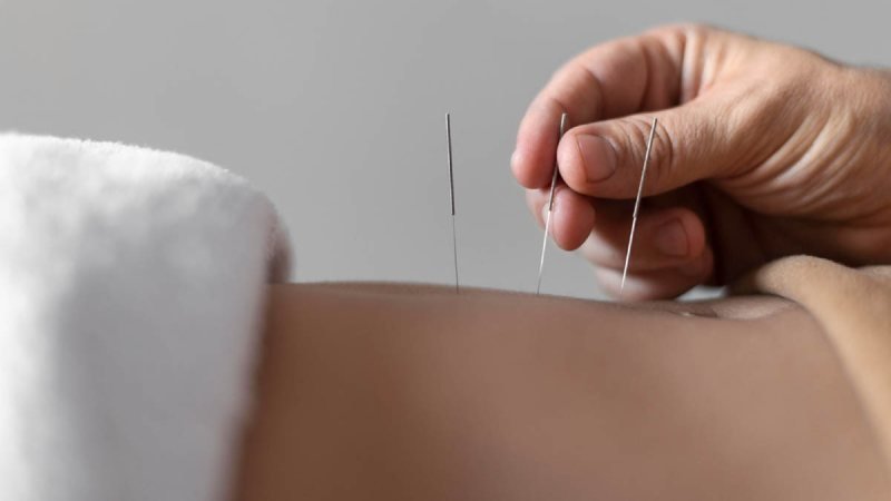 Dry Needling Explained
